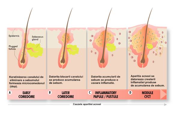 Aparitia Acneei